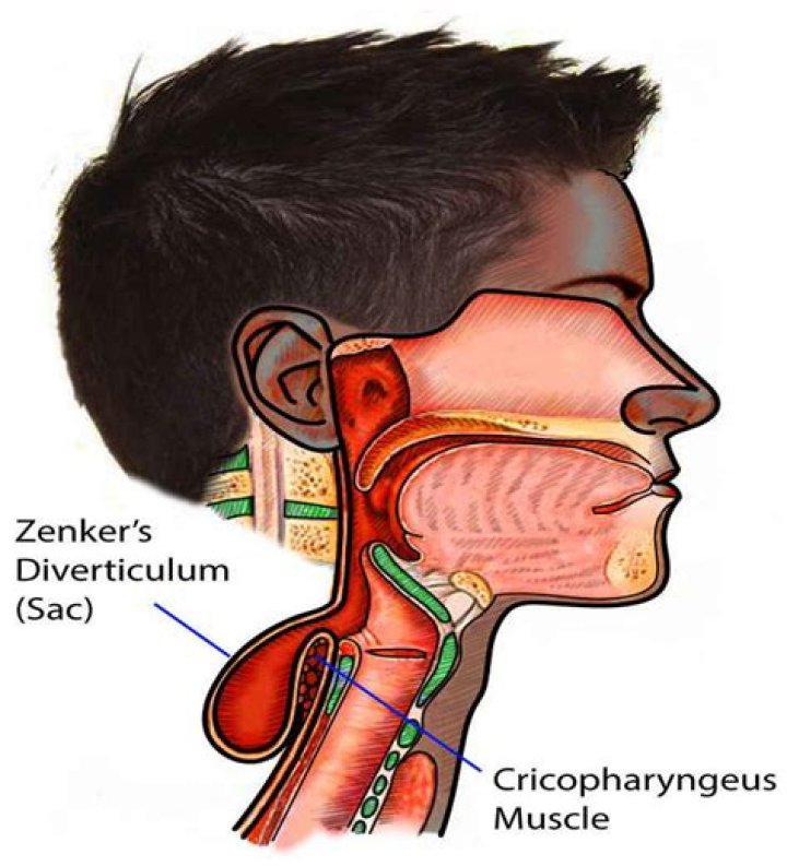 How do you get Zenkers diverticulum