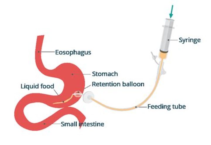 How do you insert a PEG feeding tube